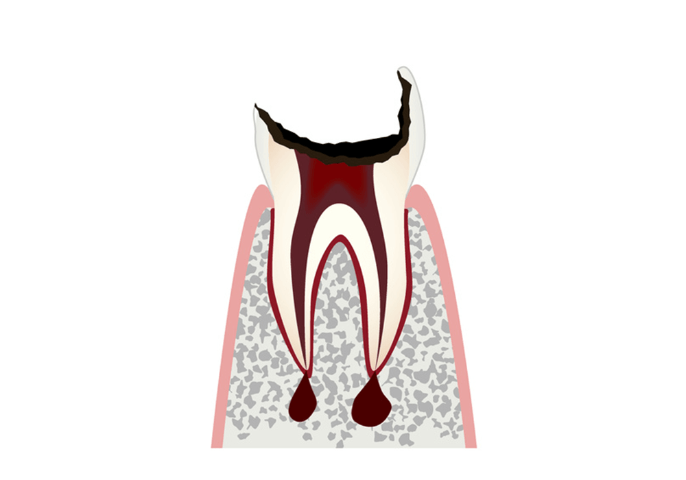 歯の根（歯質）が失われた歯